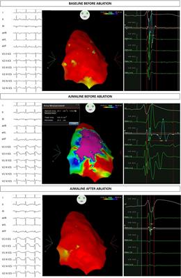 Novel SCN5A Frameshift Mutation in Brugada Syndrome Associated With Complex Arrhythmic Phenotype